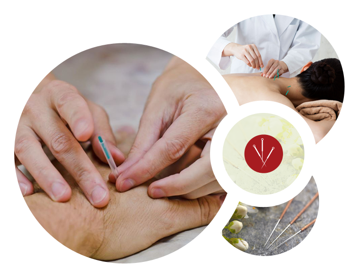 Acupuncture